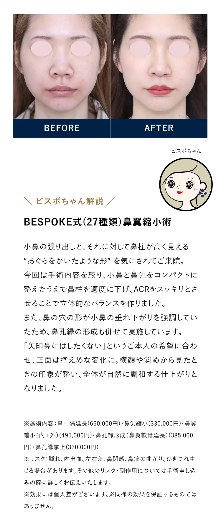BESPOKE式（27種類）鼻翼縮小術