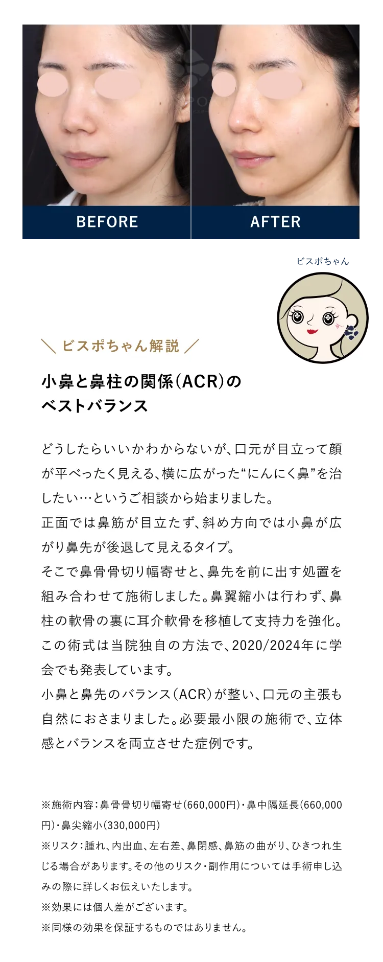 小鼻と鼻柱の関係（ACR）のベストバランス