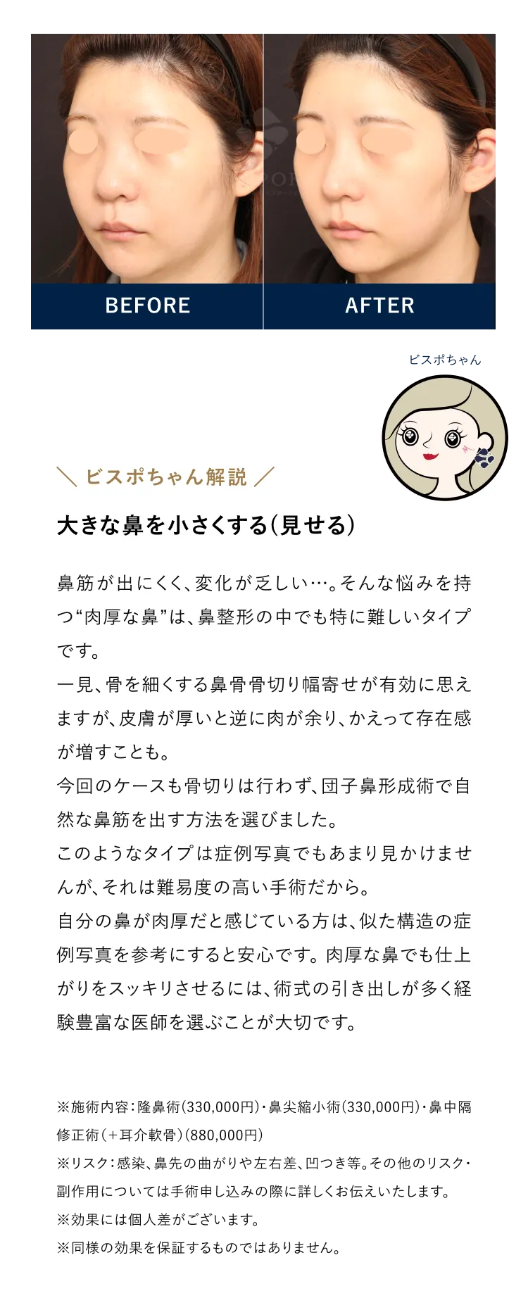 大きな鼻を小さくする（見せる）