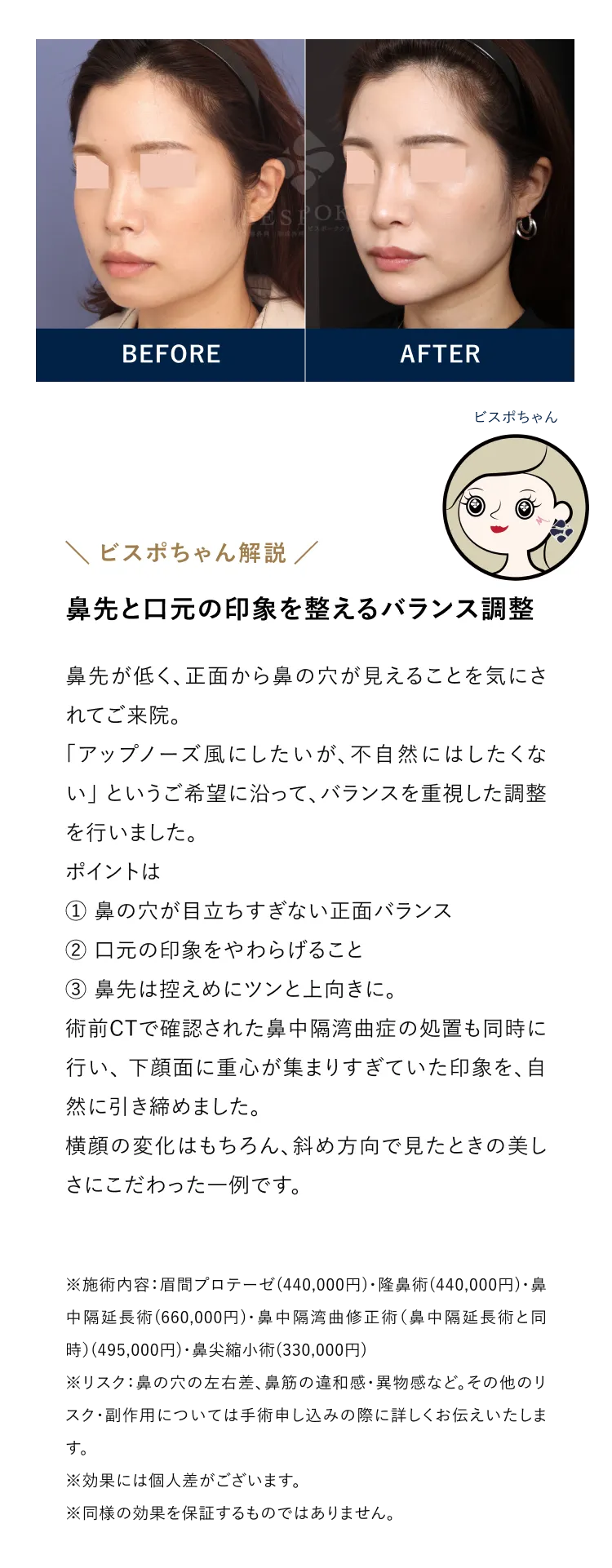鼻先と口元の印象を整えるバランス調整
