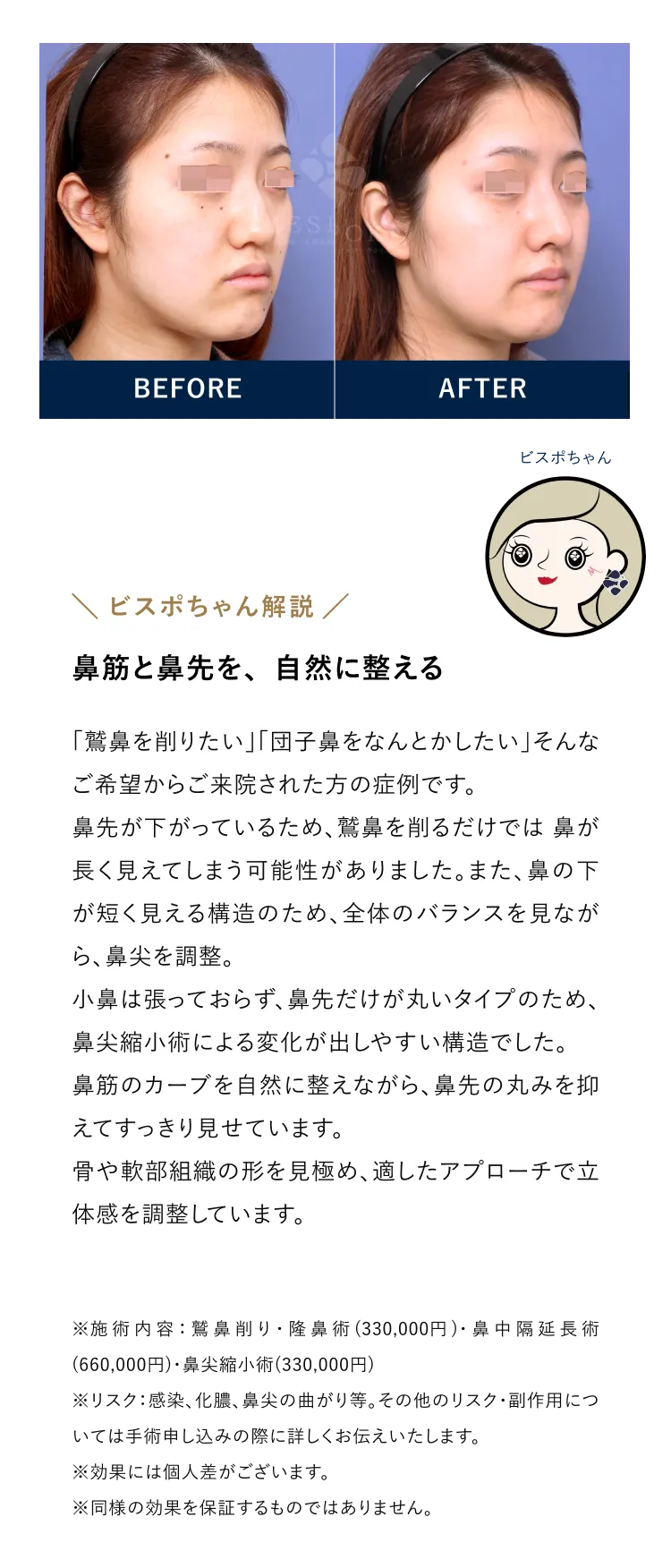 鼻筋と鼻先を、自然に整える