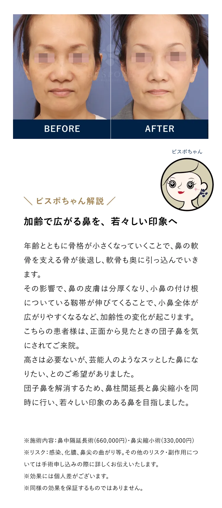 加齢で広がる鼻を、若々しい印象へ