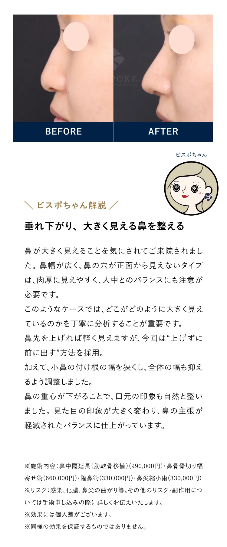 垂れ下がり、大きく見える鼻を整える