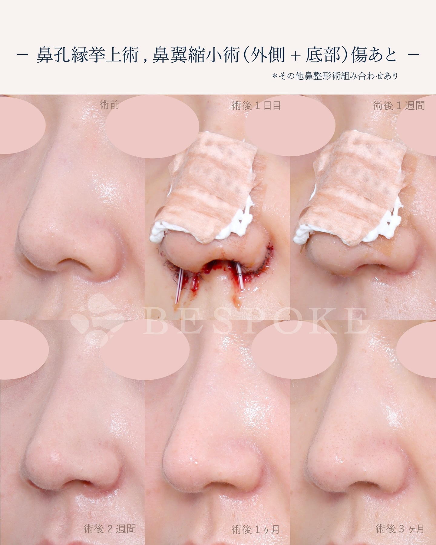 ダウンタイム・傷跡の様子