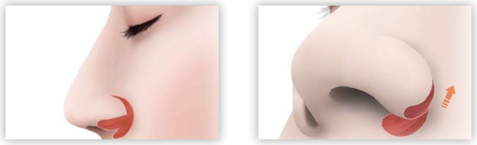 垂れ下がっている小鼻の治療 鼻の整形なら鼻の専門医 美容外科 形成外科ビスポーククリニック Bespoke 小鼻が垂れ下がっている治療