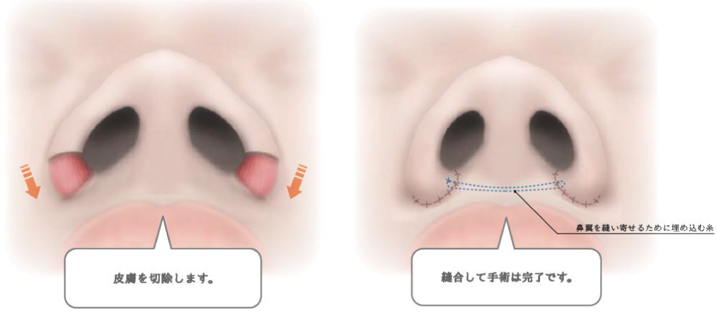 外側法は、小鼻の外側の溝に沿って余分な皮膚と組織を切除して縫合する施術です。