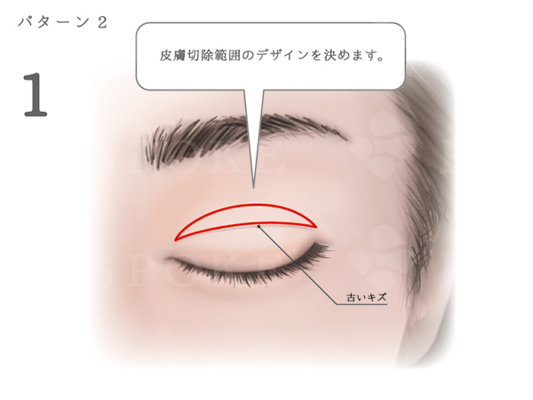 重瞼修正術 二重まぶた修正 福岡の美容外科 形成外科ビスポーククリニック