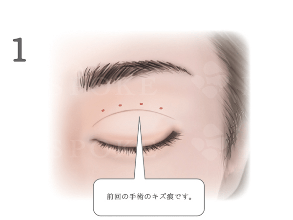 重瞼修正術 二重幅を広げる 埋没法 福岡の美容外科 形成外科ビスポーククリニック