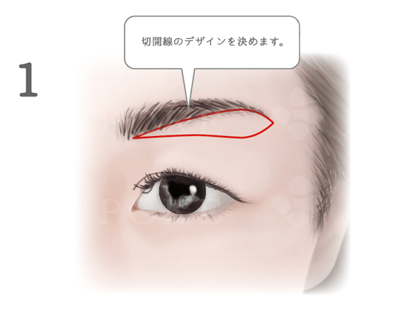 上眼瞼リフト術 眉下切開 福岡の美容外科 形成外科ビスポーククリニック