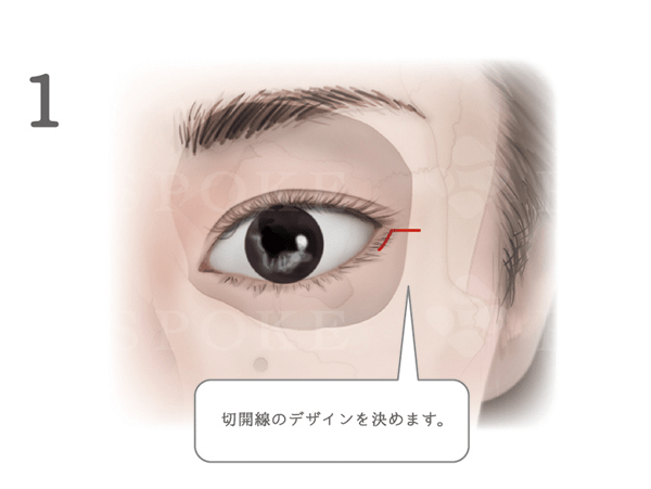 目尻外角靭帯移動術 福岡の美容外科 形成外科ビスポーククリニック