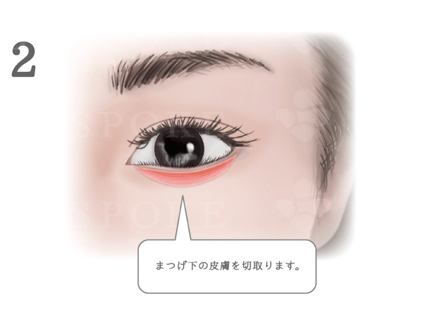睫毛内反手術 福岡の美容外科 形成外科ビスポーククリニック