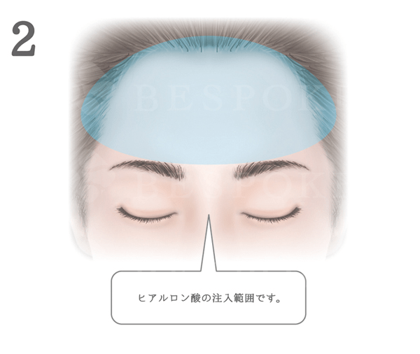 額ヒアルロン酸注入シミュレーション 福岡の美容外科 形成外科ビスポーククリニック