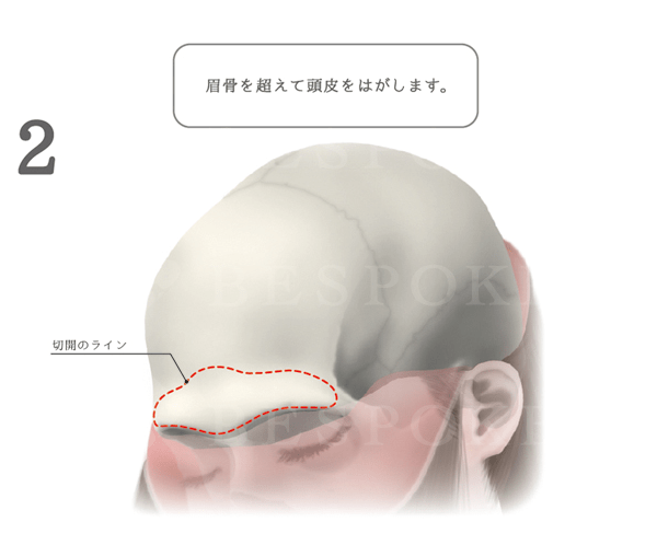 額輪郭形成 眉骨削り 福岡の美容外科 形成外科ビスポーククリニック