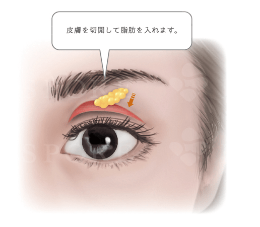 上眼瞼脂肪注入術 福岡の美容外科 形成外科ビスポーククリニック