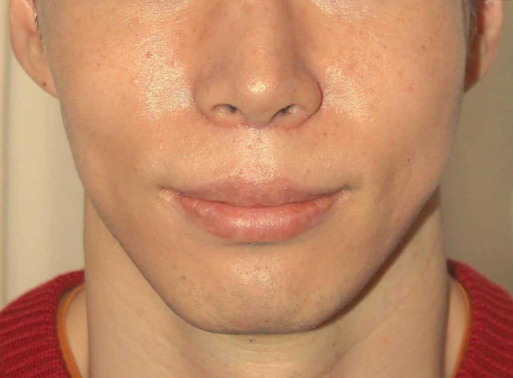 上唇のリフトアップの施術の術後写真（男性）