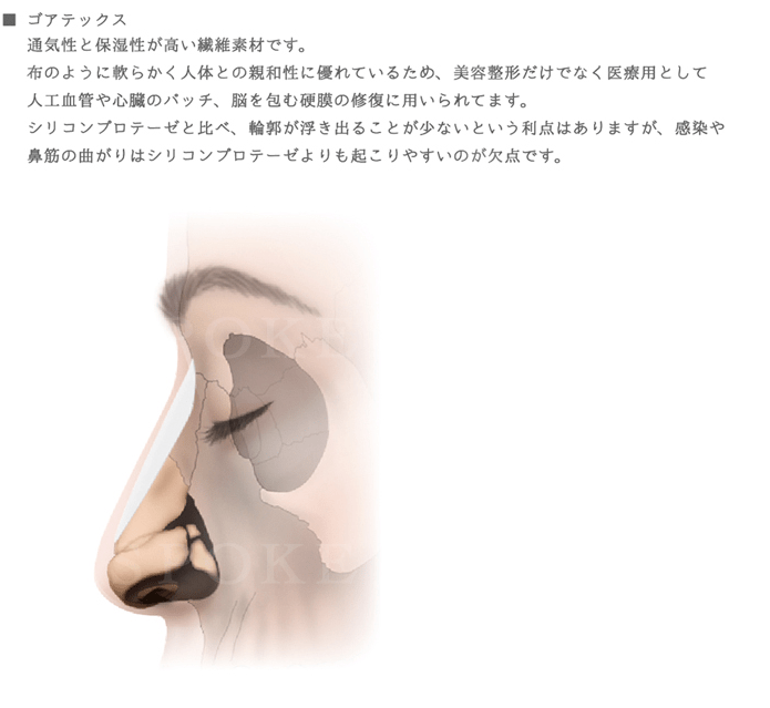 隆鼻術_シリコンプロテーゼ（ゴアテックス素材）