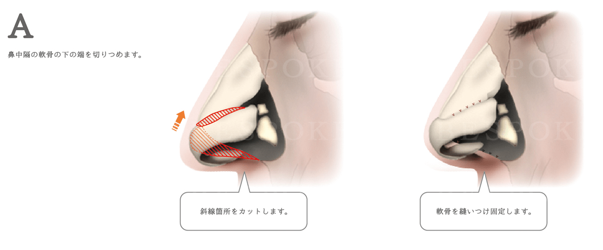 鼻短縮術_鼻が長く見える原因が軟骨の場合