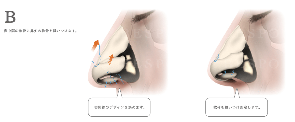 鼻短縮術_鼻が長く見える原因が皮膚の場合