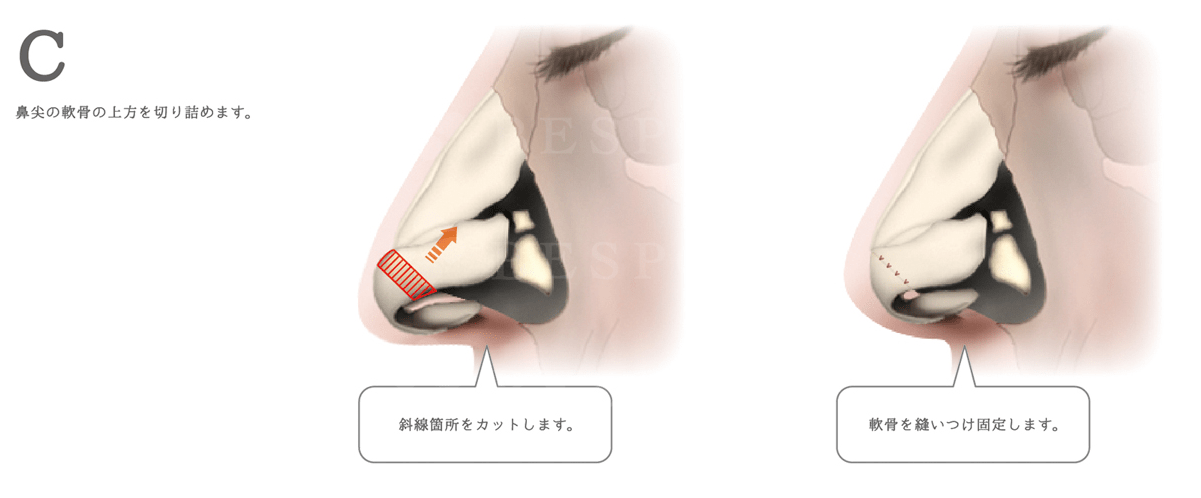 鼻短縮術_鼻が長く見える原因が軟骨と皮膚両方の場合