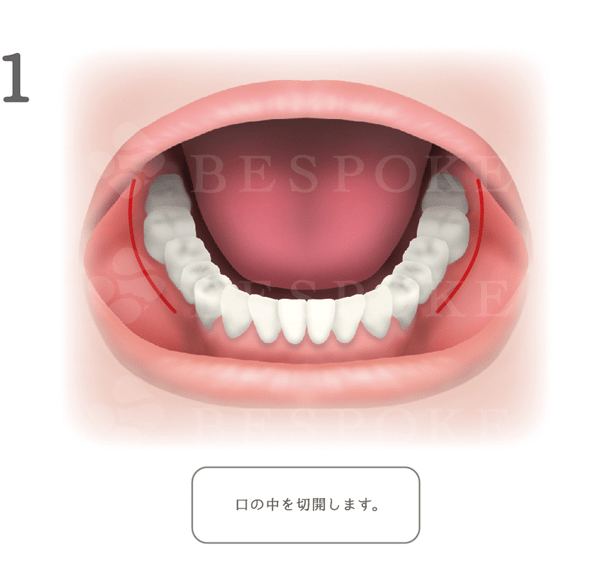 エラ削り_手術方法_口の中からのアプローチ方法