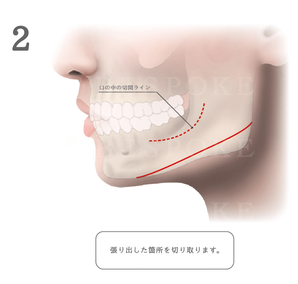 エラ削り_手術方法_口の中からのアプローチ方法_横