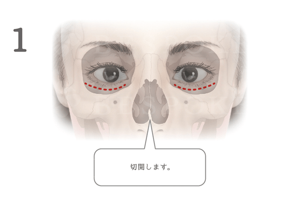 頬に高さを出すドールチーク（頬）