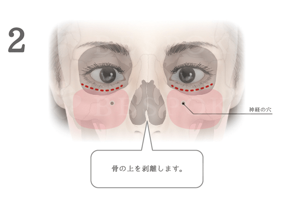 頬に高さを出すドールチーク（頬）