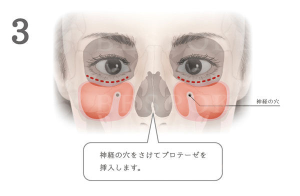 頬に高さを出すドールチーク（頬）