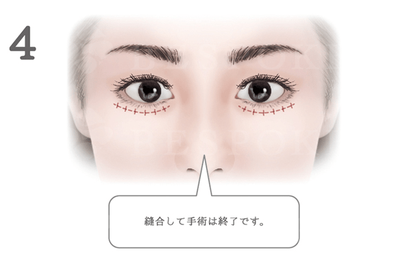 頬に高さを出すドールチーク（頬）