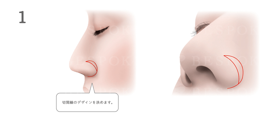 鼻翼挙上術の手術方法_切開線のデザインを決める