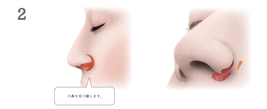 鼻翼挙上術の手術方法_小鼻を切り離す