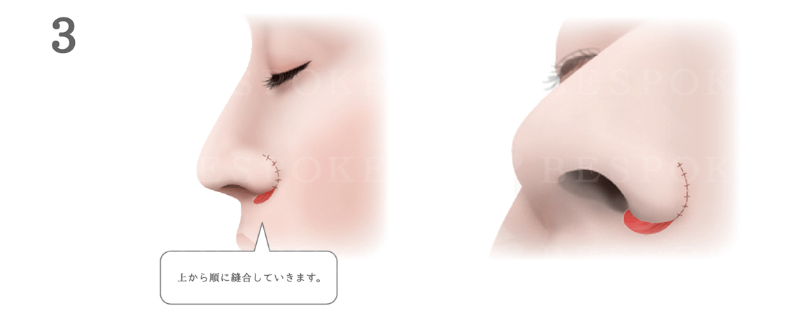 鼻翼挙上術の手術方法_上から順に縫合
