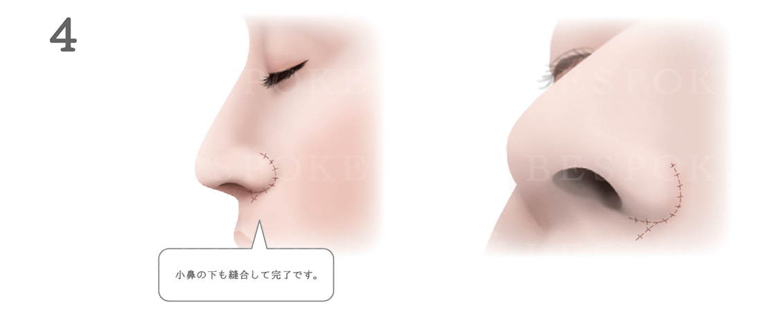 鼻翼挙上術の手術方法_小鼻の下も縫合