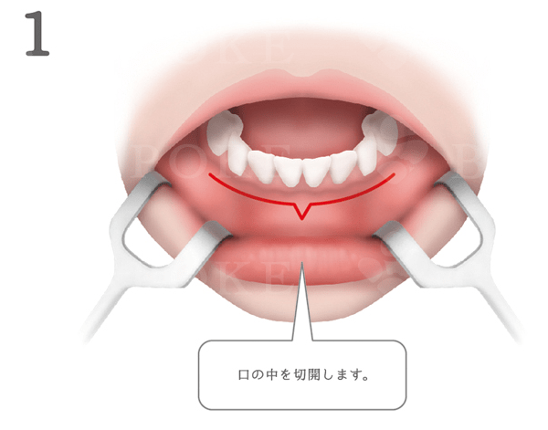 アゴ削りの手術方法