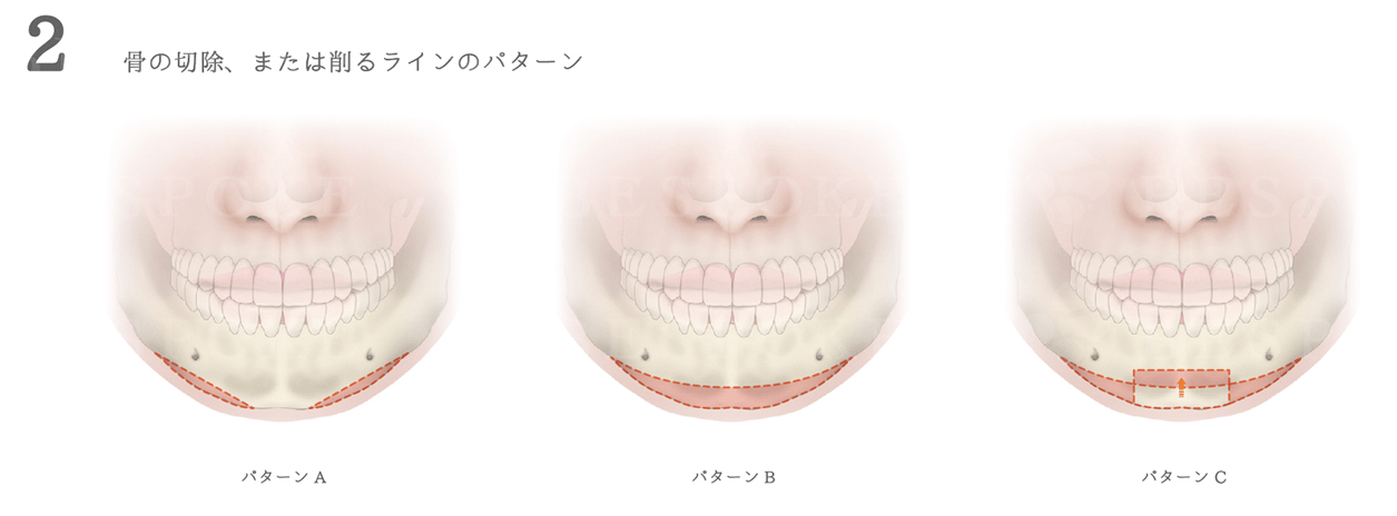 アゴ削りの手術方法