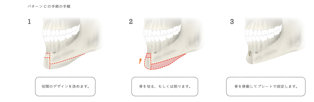 アゴ削りの手術方法