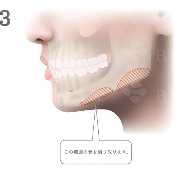 エラ削り_手術方法_削る範囲