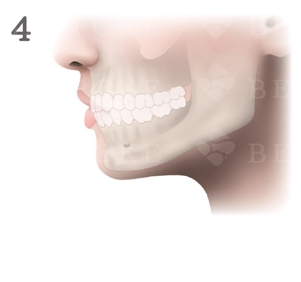 エラ削り_手術方法_完成