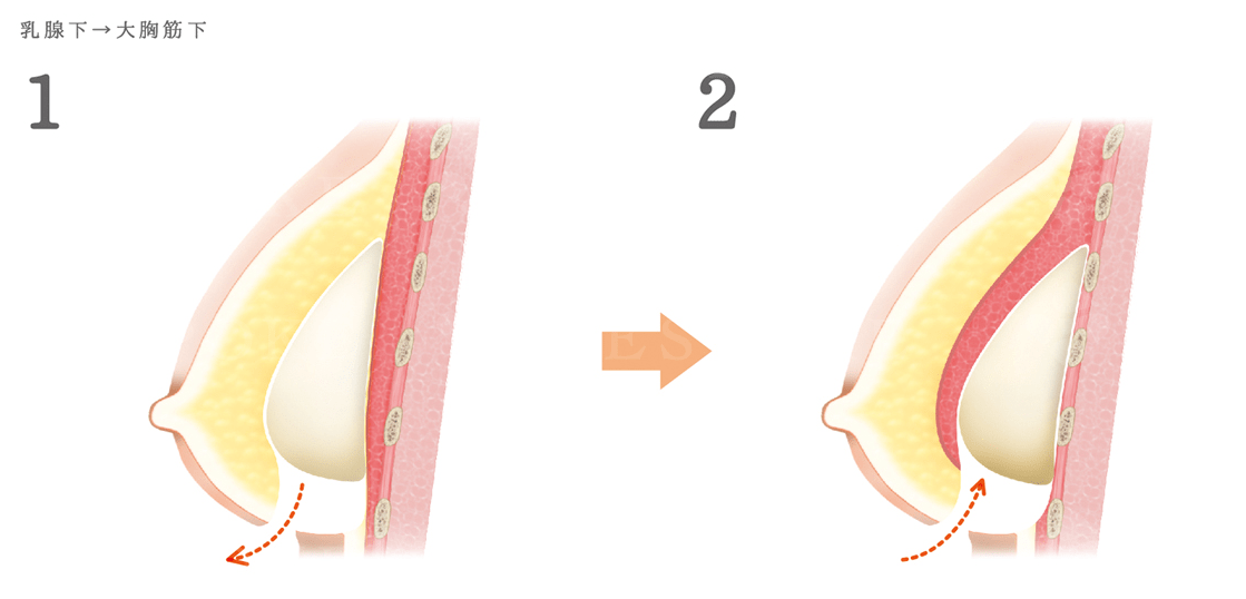 被膜拘縮解除術