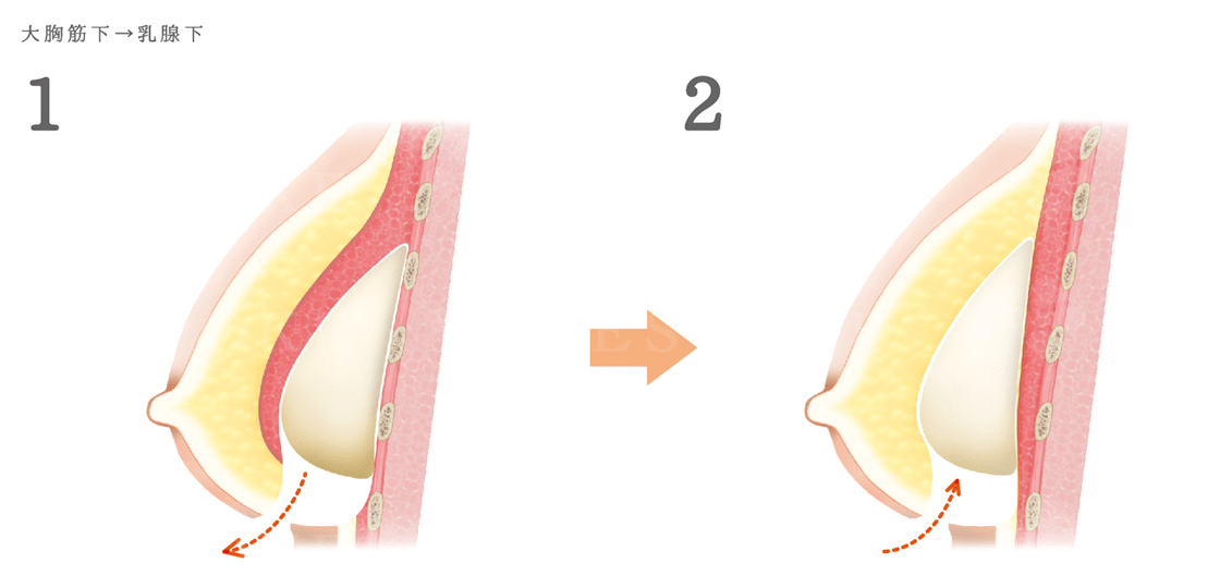 被膜拘縮解除術