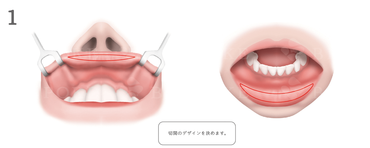 口唇縮小