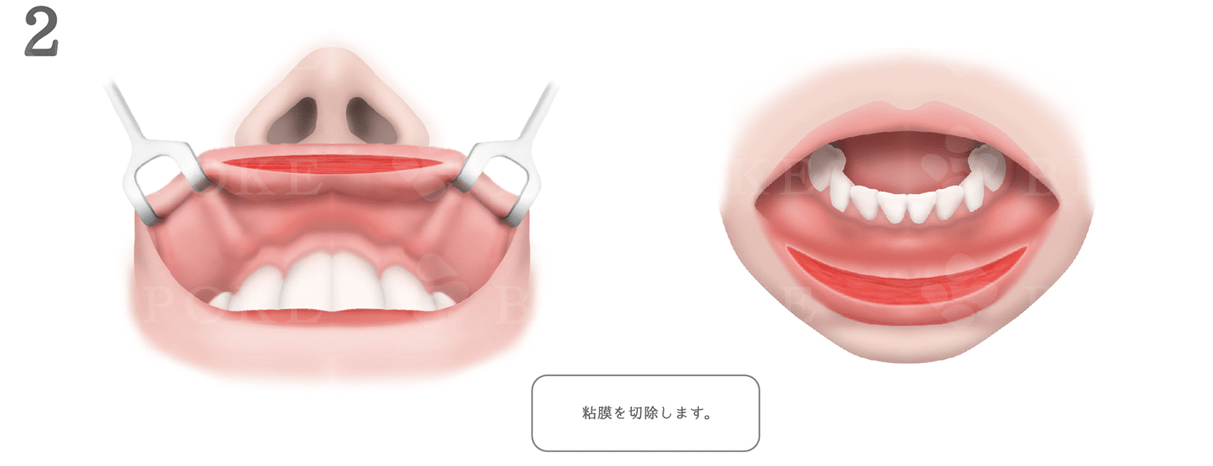 口唇縮小
