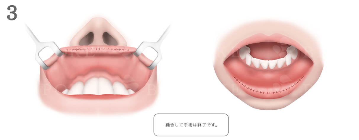 口唇縮小