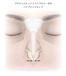 ゴアテックス＋シリコンプロテーゼのハイブリッドタイプ