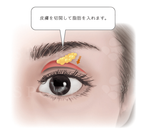 上眼瞼脂肪注入術の手術方法
