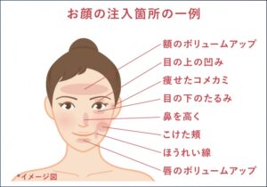 脂肪注入_お顔の注入箇所の一例