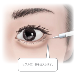 涙袋形成（ヒアルロン酸注入）