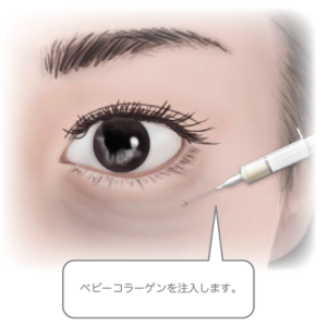 ベビーコラーゲン注入