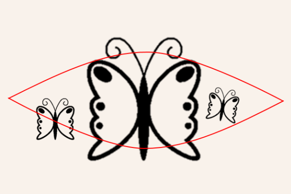 タトゥー（刺青）皮膚切除