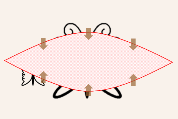 タトゥー（刺青）皮膚切除